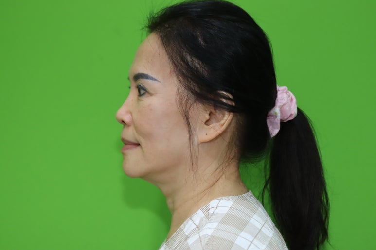Revision Facelift 3 Months Later, Including Removal of the Existing Scar image 2