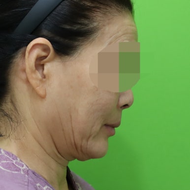안면거상술, 이중턱 근육 묶기 후 회복 기간 관련 이미지 4