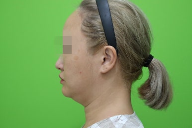 이중턱살제거, 마른 몸에 이중턱만 고민이라면? 관련 이미지 3