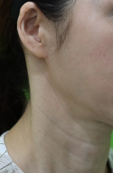 Facelift Scars, the Reason They Look Seamless After 6 Months image 5