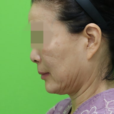 안면거상술, 이중턱 근육 묶기 후 회복 기간 관련 이미지 3