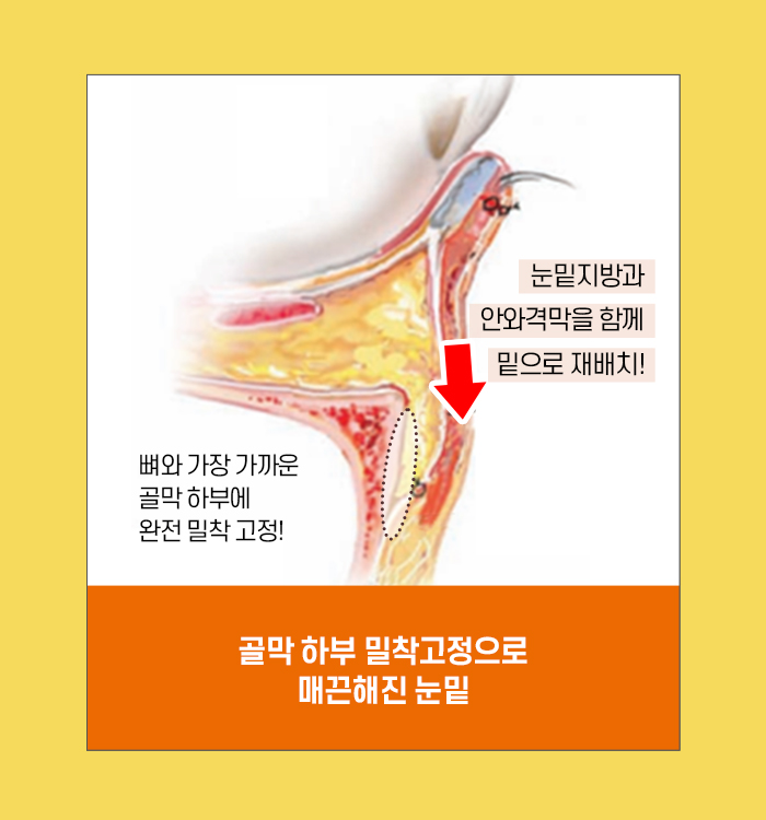 눈밑지방재배치, 수술에 대해 꼭 알아야 할 것 관련 이미지 6