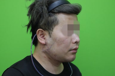 Double Chin Muscle Tying Swelling, Day 1 Appearance image 14