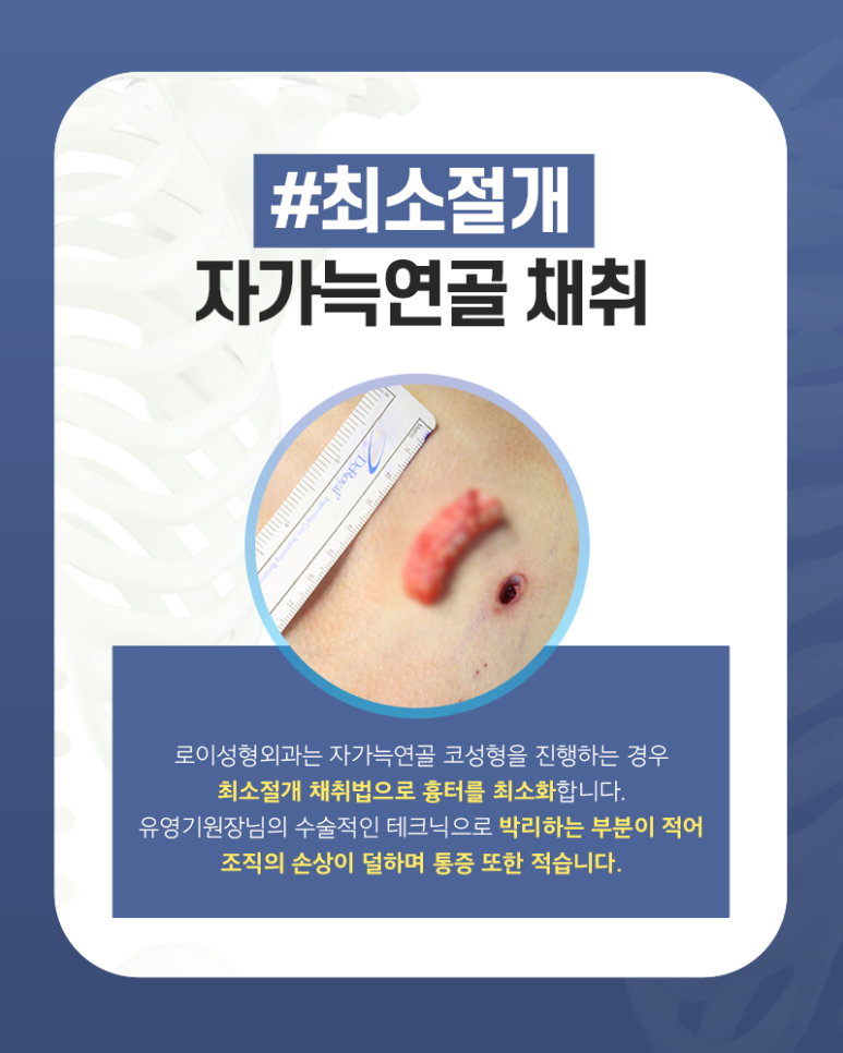 짧은코 성형, 이 2가지는 꼭 알아야 재수술 안 해요. 관련 이미지 1