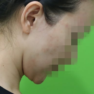 몸은 말랐는데 이중턱살제거가 시급할 때? 관련 이미지 18