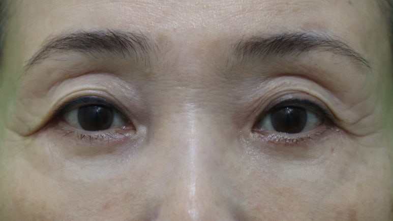 하안검수술흉터, 이 원본 사진에서 잘 보이나요? 관련 이미지 5
