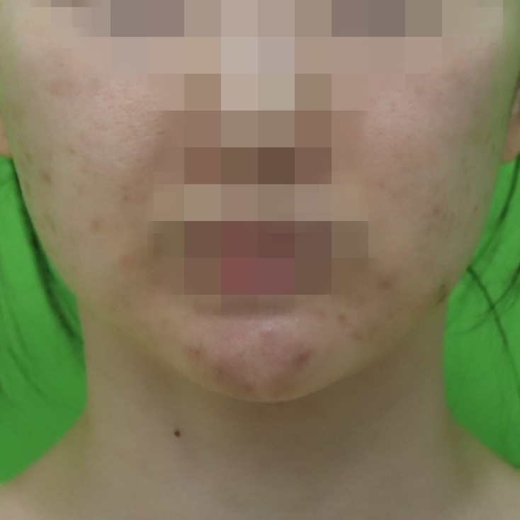 몸은 말랐는데 이중턱살제거가 시급할 때? 관련 이미지 6