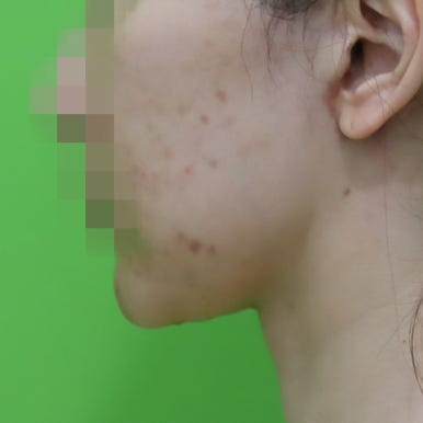 몸은 말랐는데 이중턱살제거가 시급할 때? 관련 이미지 9