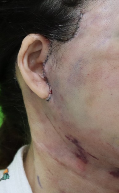 Facelift Scars, the Reason They Look Seamless After 6 Months image 7