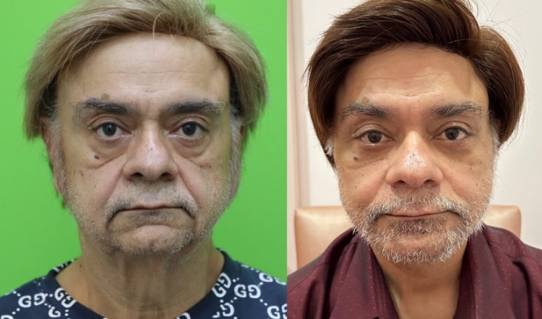 Facelift Review: Why the Neck Lift Technique Matters image 15