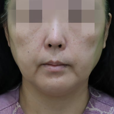 Early Swelling Changes After Facelift (Day 3, 1 Week, 2 Weeks) image 1