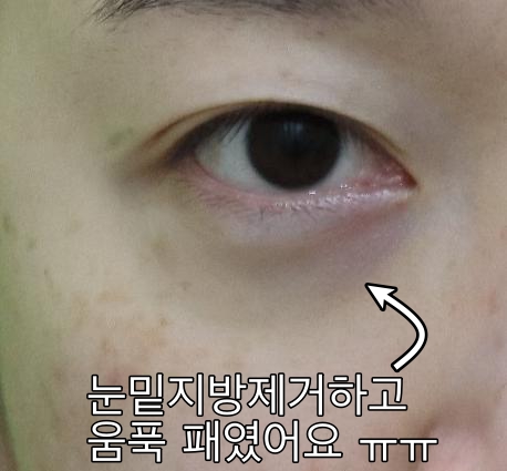 눈밑패임, 이거 모르면 효과 없는 시술에만 돈 씁니다. 관련 이미지 1