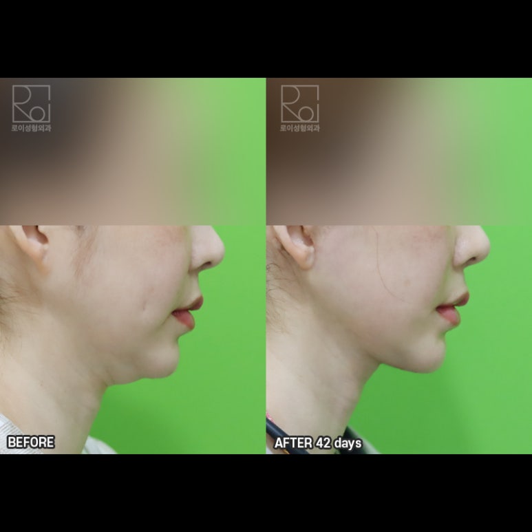 Facelift Results: Can They Be Good Even at a Young Age? image 6