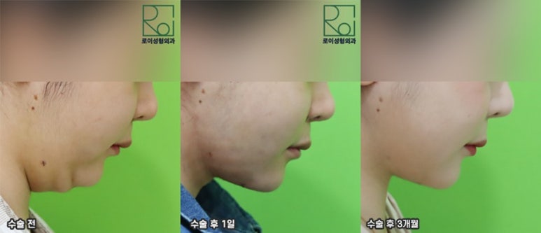 Double Chin Removal: Did You Think Liposuction Alone Would Be Enough? image 6