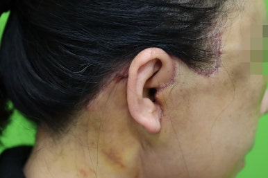 Early Swelling Changes After Facelift (Day 3, 1 Week, 2 Weeks) image 21