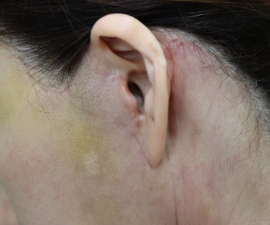 Facelift Scars, the Reason They Look Seamless After 6 Months image 16