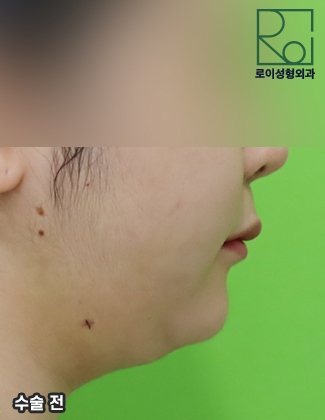 Double Chin Removal: Did You Think Liposuction Alone Would Be Enough? image 1