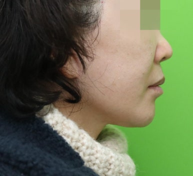 안면거상 재수술, 왜 3년전 수술이 효과가 없었을까? 관련 이미지 18