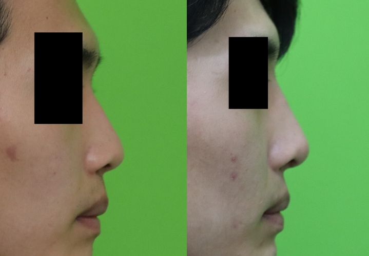 Crooked Nose Surgery: If You Don’t Know This, You’ll Need Revision Surgery Again. image 10