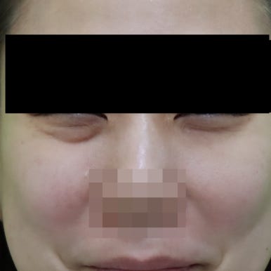 웃을때 눈밑지방, 정말 근육이라 개선이 안될까? 관련 이미지 3