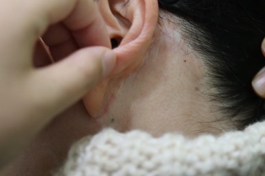 안면거상 재수술, 왜 3년전 수술이 효과가 없었을까? 관련 이미지 28