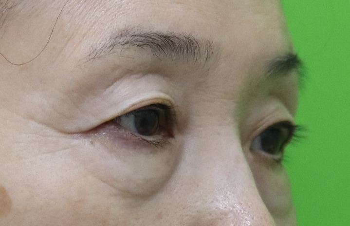 하안검수술흉터, 이 원본 사진에서 잘 보이나요? 관련 이미지 3
