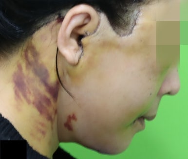 Early Swelling Changes After Facelift (Day 3, 1 Week, 2 Weeks) image 16