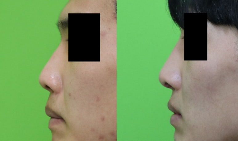 Crooked Nose Surgery: If You Don’t Know This, You’ll Need Revision Surgery Again. image 13