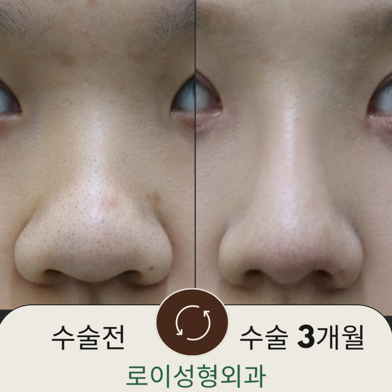 복코성형, 연예인 지망생의 리얼 후기 관련 이미지 21