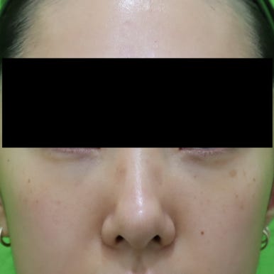 눈밑지, 지방이식 같이 하면 회복이 더 오래 걸리나? 관련 이미지 4