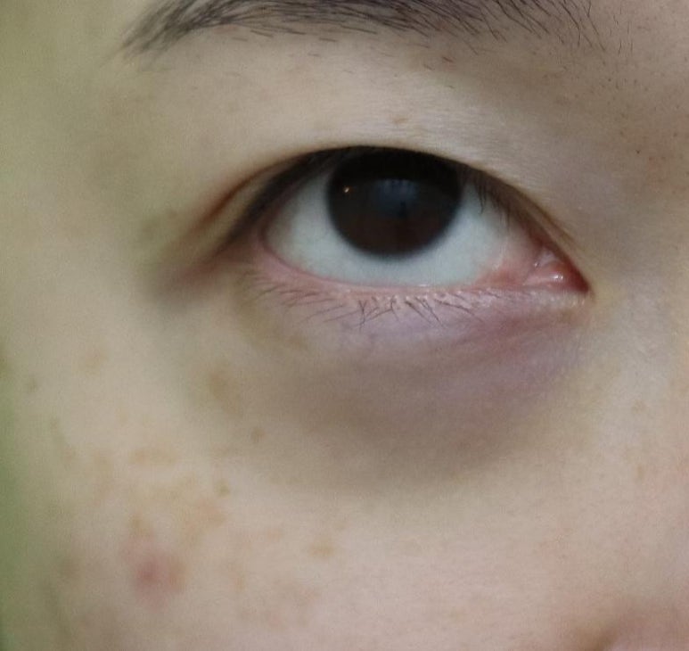 눈밑패임, 이거 모르면 효과 없는 시술에만 돈 씁니다. 관련 이미지 4