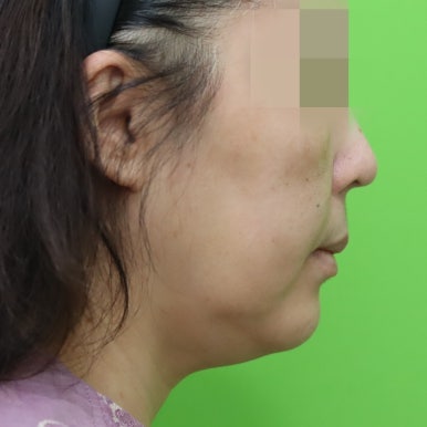 Early Swelling Changes After Facelift (Day 3, 1 Week, 2 Weeks) image 3