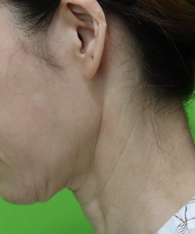 Facelift Scars, the Reason They Look Seamless After 6 Months image 4