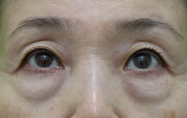 하안검수술흉터, 이 원본 사진에서 잘 보이나요? 관련 이미지 10