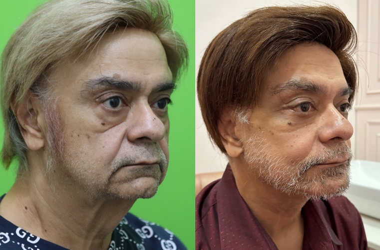Facelift Review: Why the Neck Lift Technique Matters image 16