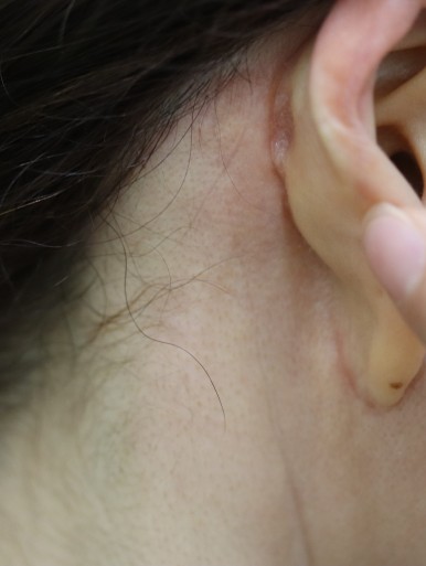 Facelift Scars, the Reason They Look Seamless After 6 Months image 20