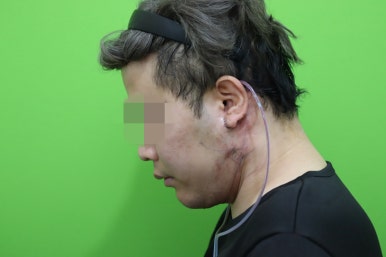 Double Chin Muscle Tying Swelling, Day 1 Appearance image 12