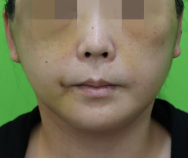 Early Swelling Changes After Facelift (Day 3, 1 Week, 2 Weeks) image 17