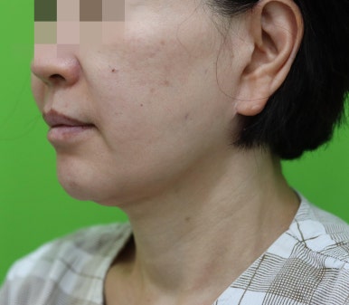 안면거상 재수술, 왜 3년전 수술이 효과가 없었을까? 관련 이미지 21