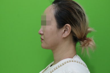 이중턱살제거, 마른 몸에 이중턱만 고민이라면? 관련 이미지 10
