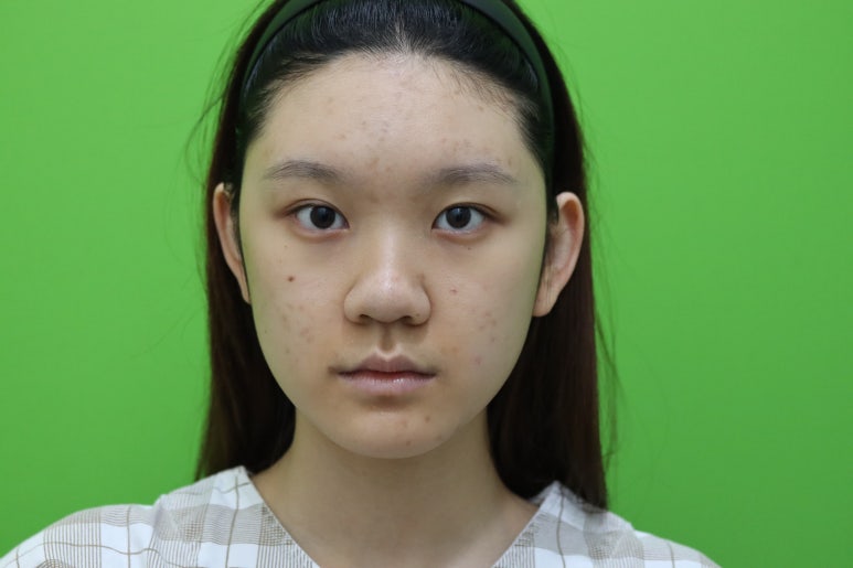 복코성형, 연예인 지망생의 리얼 후기 관련 이미지 2