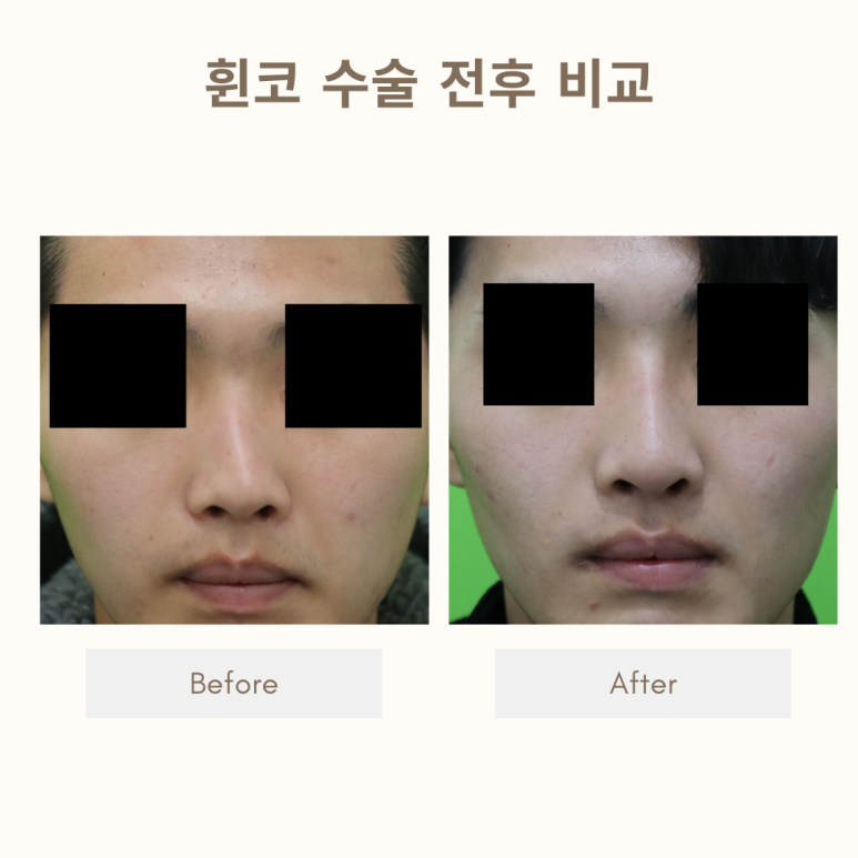 Crooked Nose Surgery: If You Don’t Know This, You’ll Need Revision Surgery Again. image 16