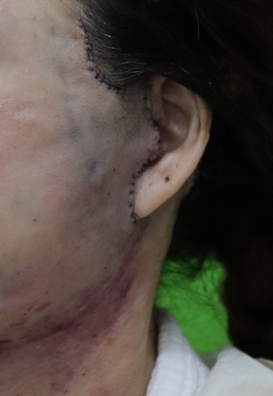 Facelift Scars, the Reason They Look Seamless After 6 Months image 9