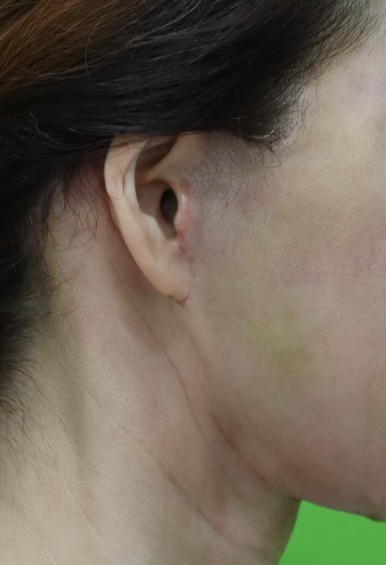 Facelift Scars, the Reason They Look Seamless After 6 Months image 12