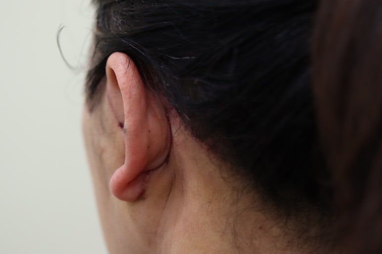 Early Swelling Changes After Facelift (Day 3, 1 Week, 2 Weeks) image 23