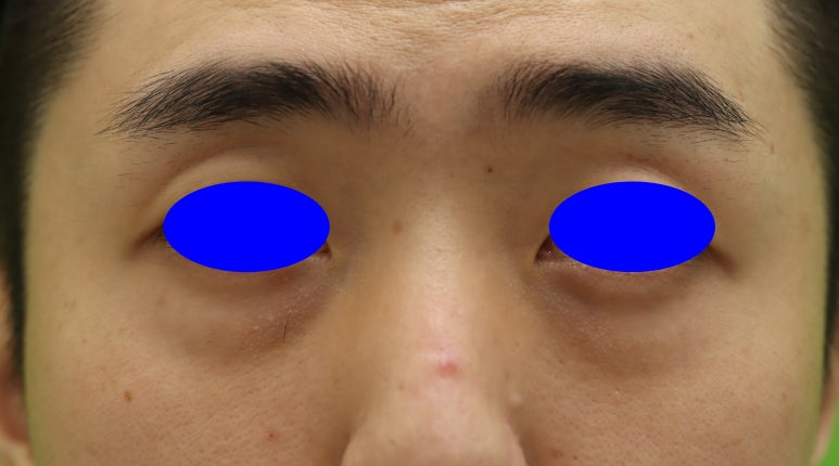 3 Things You Must Know Before Male Under-Eye Fat Repositioning image 2