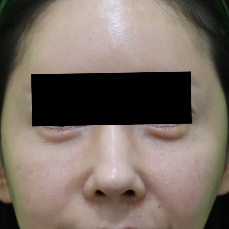 부자연스러운 애교살 지방이식 제거, 수술 후기 관련 이미지 1
