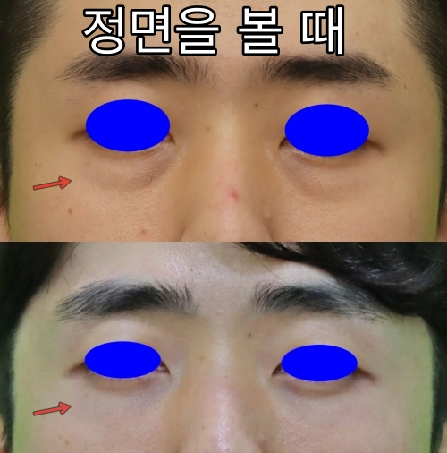 3 Things You Must Know Before Male Under-Eye Fat Repositioning image 4