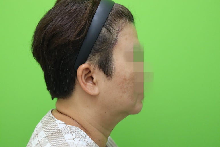 이중턱살, 설마 아직도 지방인줄 알고 계셨나요? 관련 이미지 3