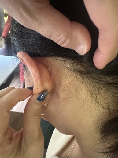 Revision Facelift 3 Months Later, Including Removal of the Existing Scar image 16